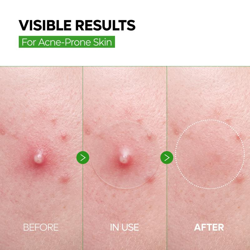 Zero-Fit Korean Pimple Patch Duo